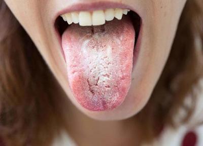 برفک دهان چیست؟ علائم و راه های درمان آن را بشناسید