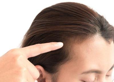 عوامل ریزش مو در زنان