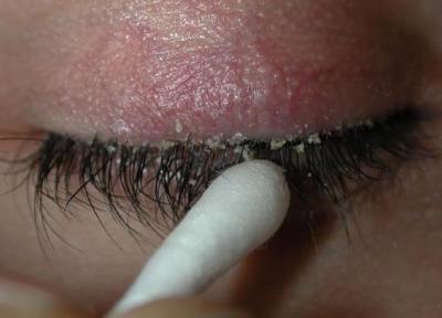 با این 6 روش شوره زدن مژه ها را از بین ببرید!